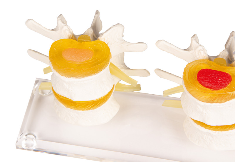 Modèle - Dégénérescence de la colonne lombaire