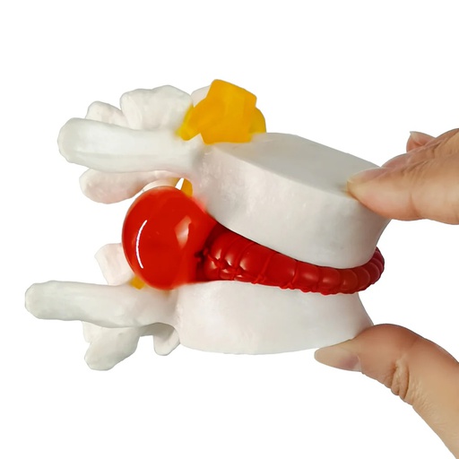 [110-252] Anatomical model - Herniated disc simulator